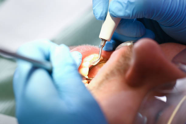 Best Emergency Tooth Extraction in Harpersville, AL